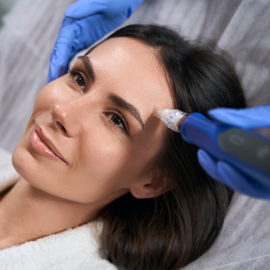 Microneedling