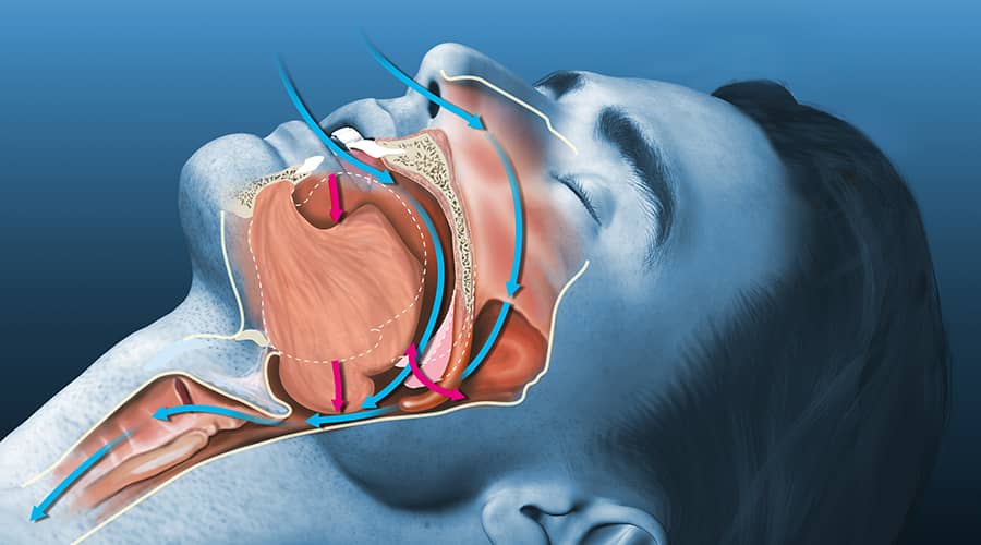 The Hidden Risk of Undiagnosed Obstructive Sleep Apnea in the Perioperative Period